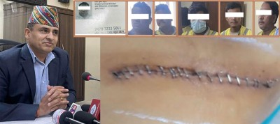  सिन्धुपाल्चोकका श्यामकृष्ण भण्डारीले बेचे १०० भन्दा बढी नेपालीको मिर्गौला 
